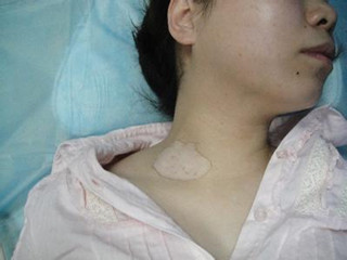 女性白癜风的发病并发偶然 女性白癜风的发病并发偶然