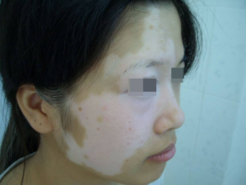 女性白癜风的诱发原因有哪些