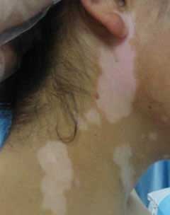 女性白癜风患者需要注意的问题有哪些呢